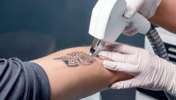 Solutions efficaces pour effacer ses tatouages à Lyon